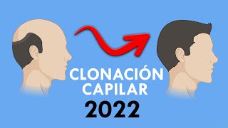 CLONACION de PELO explicado por MEDICO ¿Disponible 2022 [upl. by Iviv]