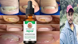 onychomycosis repair  nails repair serum growth nails  honest review [upl. by Flin551]