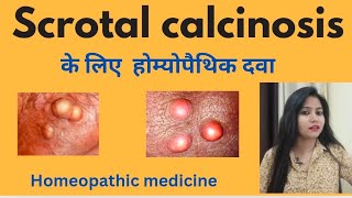 Scrotal calcinosis treatment  Scrotal calcinosis symptomscauses amp homeopathic medicine in hindi [upl. by Siri]