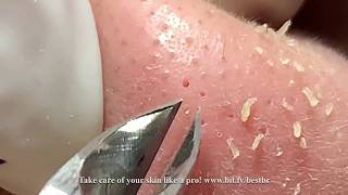 Blackhead Extraction Masterclass Achieve Clear Skin  bitlybestbr [upl. by Safko]