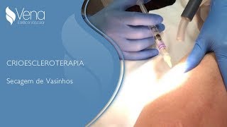 Secagem de Vasinhos  Crioescleroterapia  Vena Estética Vascular [upl. by Alledi]