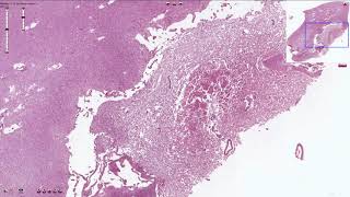 Encephalomalacia  Histopathology [upl. by Adnaluy]