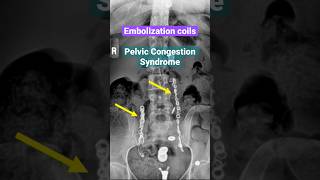 Embolization coils for pelvic congestion syndrome xray medical abdomen [upl. by Follansbee900]