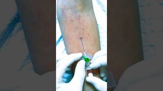 IV Cannulation techniques subscribe cannula cannulainsertion shortsindia [upl. by Antonia]