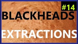 BLACKHEADS EXTRACTIONS on Happy 14 [upl. by Zephaniah]