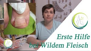 Erste Hilfe bei Wildem Fleisch podologinandrea [upl. by Aenotna]