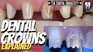 DENTAL CROWNS Patients Request to Make Her Teeth Uniform 4k c34 dentist [upl. by Miguelita]