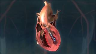 Impella  Eternal Hospital  Worlds Smallest Heart Pump [upl. by Irrahs]