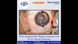 Surgery of Toric Implantable Phakic Contact Lens [upl. by Sachiko]