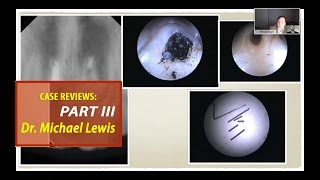 Case Reviews with Dr Michael Lewis Part 3 of 3 [upl. by Akirderf]