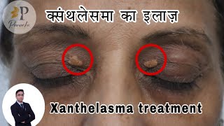 Xanthelasma Surgery in Delhi  Xanthelasma Treatment  Xanthelasma Removal  xanthelasma [upl. by Abagael]