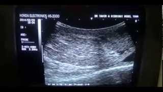 INGUINAL HERNIA by ultrasound [upl. by Ymmit]