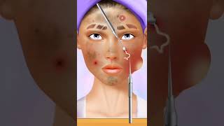 Pimple Blackheads remove ytshortsasmracnetreatment [upl. by Fulcher]