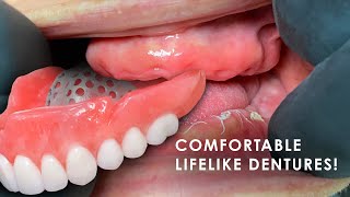 How to Create Comfortable Lifelike Dentures [upl. by Rees]