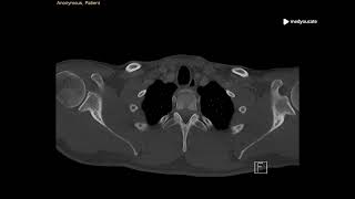 Mediastinal Emphysema  Pneumomediastinum  MedYouCate [upl. by Esyak]