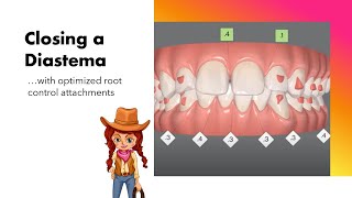 Invisalign ClinCheck  Closing a diastema with root control attachments [upl. by Vaughn626]