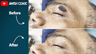 SEBORRHEIC KERATOSIS TREATMENT  Skin Horn सींग removal  By Dr Vijay Kumar [upl. by Lateh]