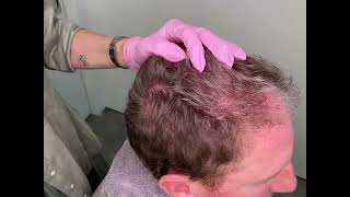 MicroNeedling for Hair Restoration [upl. by Hadik]