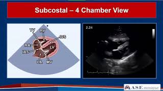 Guidelines for Performing a Comprehensive TTE in Adults Webinar [upl. by Eiramac71]