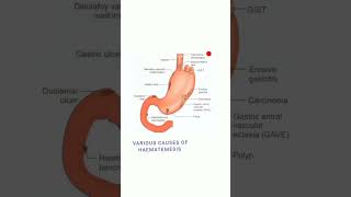 VARIOUS CAUSES OF HAEMATEMESIS ACCORDING TO SITE  DIAGRAMsurgery [upl. by Hoi927]