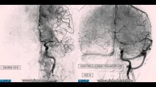 Angiographie cérébrale avant et après thrombectomie [upl. by Attenev]