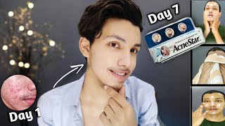 Acne Star Gel  How To Use  Result  Really Works  Honest Review  Acne Pimple Spots  Hindi [upl. by Gibson96]