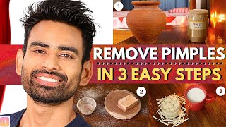 ULTIMATE Ayurvedic Routine to Get Rid of Pimples amp Acne Permanently Men amp Women [upl. by Schubert856]