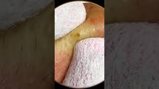 Removing Acne acnes skincare skintreatment [upl. by Aisa663]