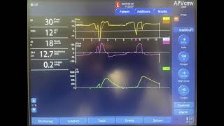 A Case of Patientventilator Asynchrony [upl. by Eiramaliehs]