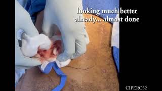 Large Abscess IampD  Right lower back [upl. by Nash]