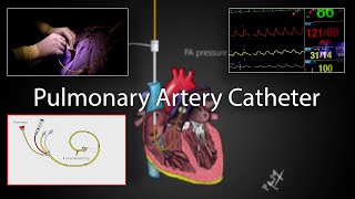 Pulmonary artery catheter SwanGanz Catheter placement and physiology [upl. by Rombert398]