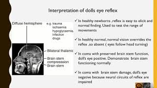 Dolls eye Reflex [upl. by Denbrook498]