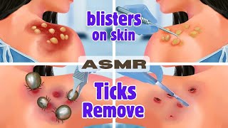 ASMR giant ticks removal  Blisters on skin infaction animation [upl. by Airdni]