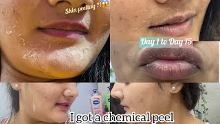 I got a chemical peel treatment for acne scars amp pigmentation  Skin Peeling  Experience [upl. by Rotsen]