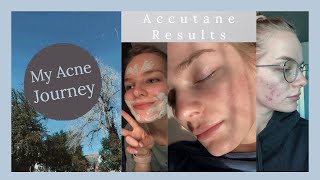 Accutane RESULTS  2040mg LOW DOSE [upl. by Iahk]