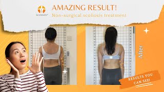 Isabelle Scoliosis Results at ScolioLife Clinic  42 to 25 degrees in 6 months scoliosistreatment [upl. by Isewk]