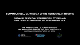 Squamous cell carcinoma of the retromolar trigone Resection and free fibula flap reconstruction [upl. by Yasu459]