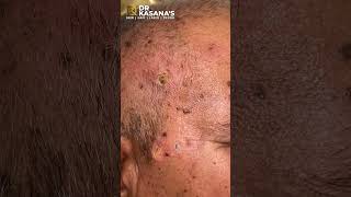 Seborrheic Keratosis Treatment  at Dr Kasana clinic [upl. by Kir]