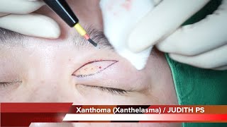 Xanthoma Xanthelasma removal surgery 안검황색종 [upl. by Sivrahc]