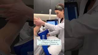 CoolSculpting Elite at The Skin Center [upl. by Pardner]