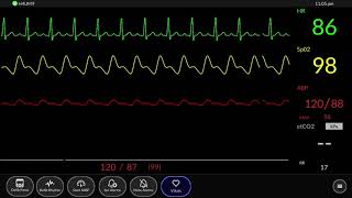 Simulated Patient Monitor  Normal Sinus Rhythm [upl. by Simonsen]