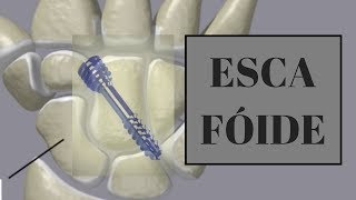 Cirurgia Escafoide com Anestesia Local [upl. by Edith519]