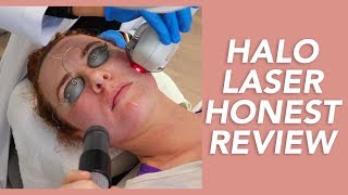 My Halo Laser Experience Honest Review Recovery and Before amp Afters [upl. by Whitehurst]