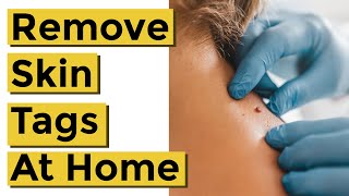 How to Quickly and Easily Remove Skin Tags at Home Using Things You Already Own [upl. by Sedgewinn]