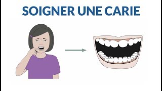 Comment soigner une dent cariée [upl. by Ilat301]