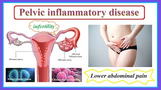 pelvic inflammatory disease [upl. by Laehcimaj]