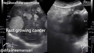 Liver cancer I Hepatic cancer I Hepatocellular carcinoma I Malignant hepatoma [upl. by Maon]