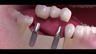 Le BRIDGE sur IMPLANTS dentaires  le pont dentaire sur implants [upl. by Arised]