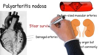 Polyarteritis nodosa made easy [upl. by Trudey]