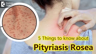 5 Things to know about Pityriasis Rosea  Pityriasis Rosea Rash  Dr Divya SharmaDoctors Circle [upl. by Eelesor]